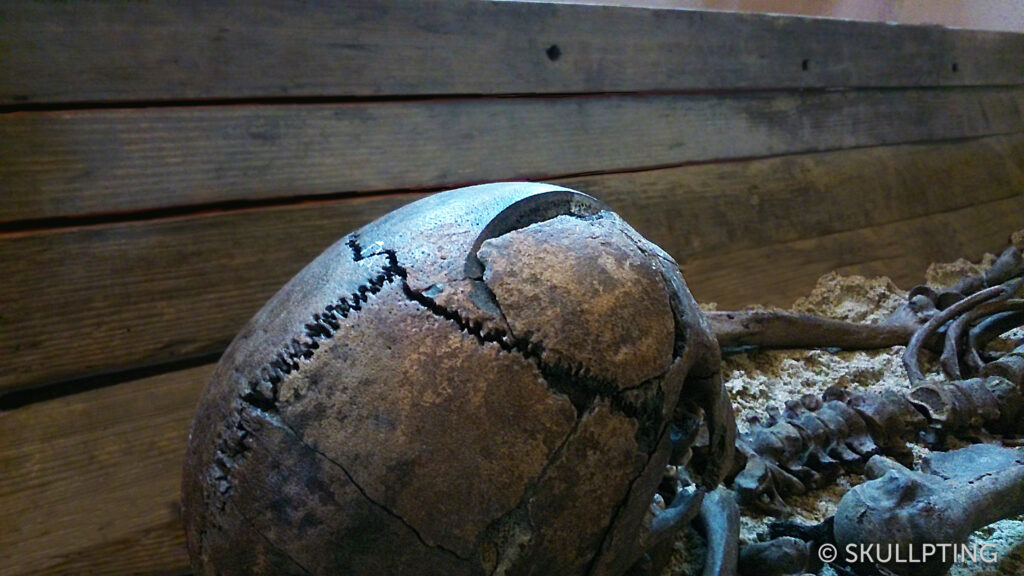 [en:]Skull with head wound.[nl:]Schedel met verwonding.[:]