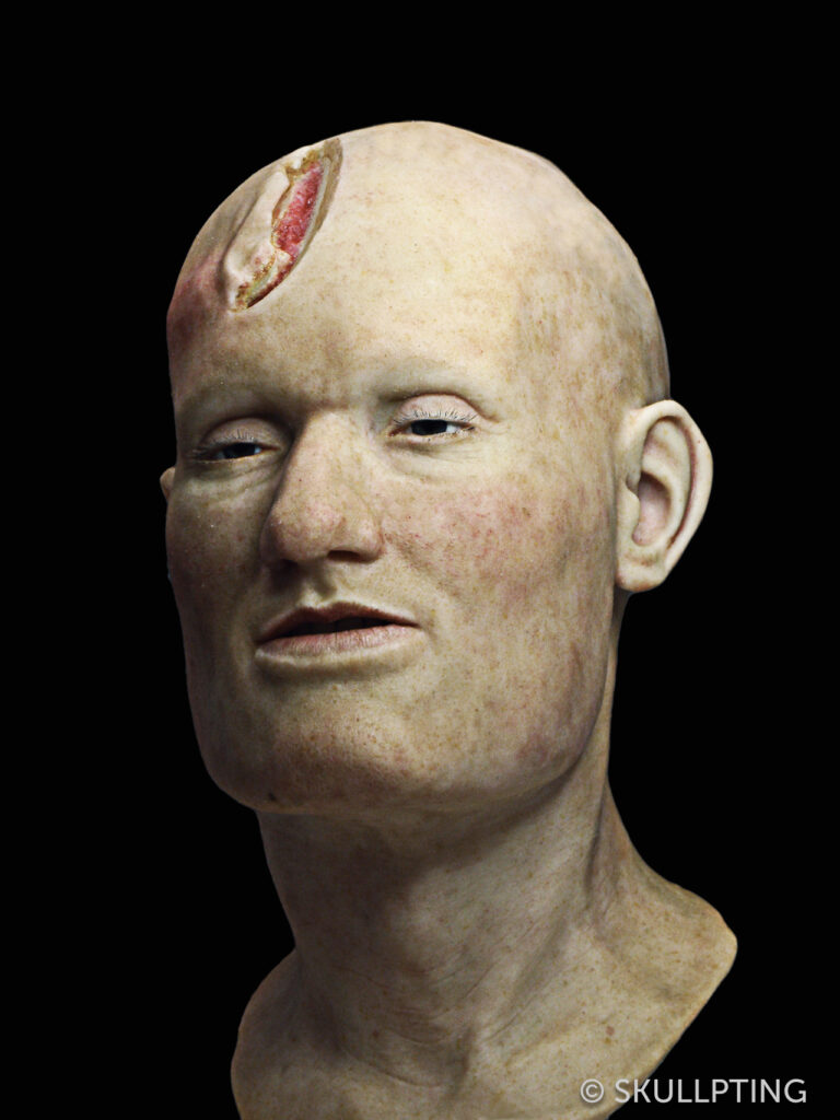 [en:]Facial reconstruction with head wound.[nl:]Gezichtsreconstructie met verwonding.[:]